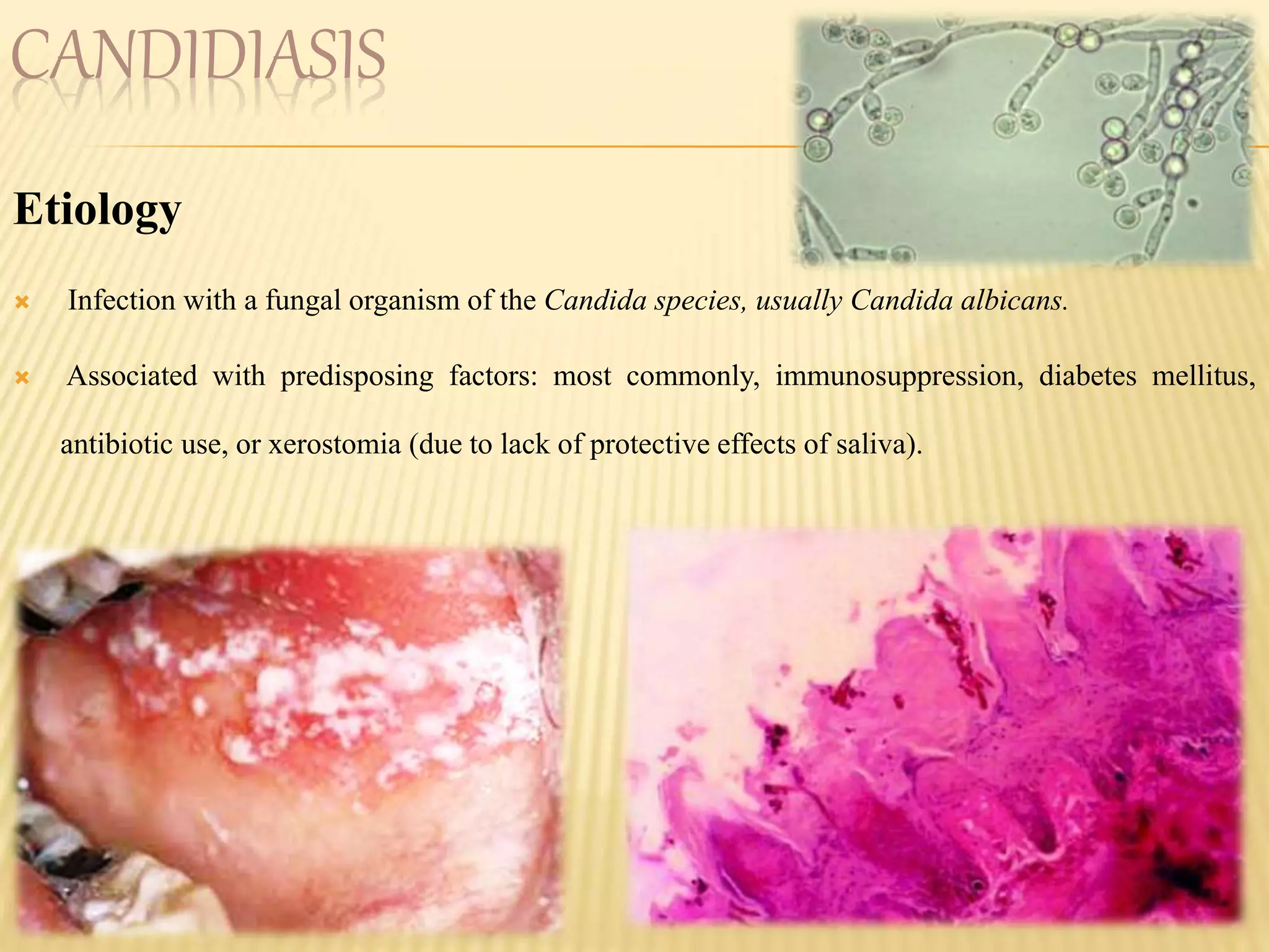 CANDIDIASIS
Etiology
 Infection with a fungal organism of the Candida species, usually Candida albicans.
 Associated with predisposing factors: most commonly, immunosuppression, diabetes mellitus,
antibiotic use, or xerostomia (due to lack of protective effects of saliva).
 