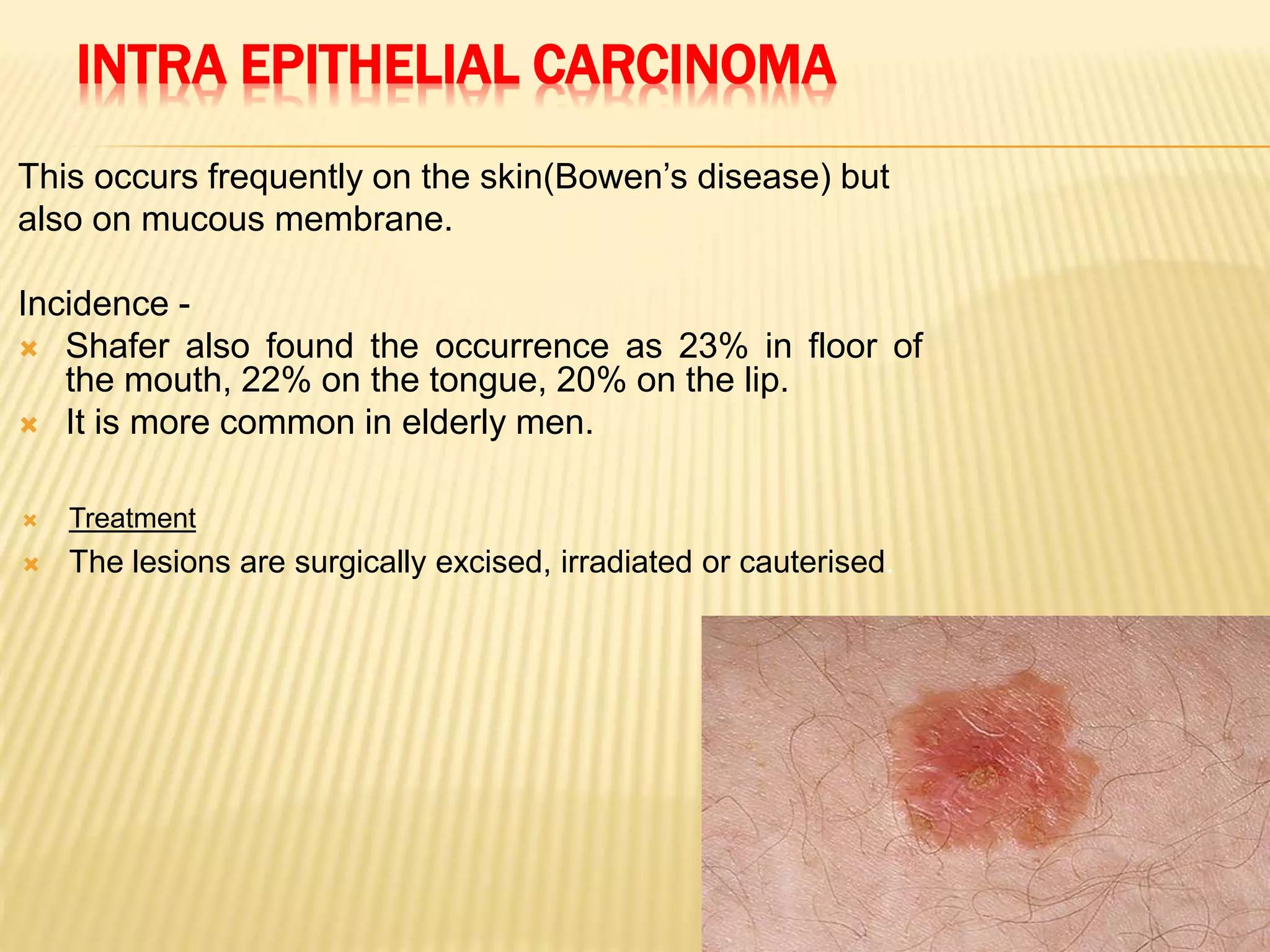 INTRA EPITHELIAL CARCINOMA
This occurs frequently on the skin(Bowen’s disease) but
also on mucous membrane.
Incidence -
 Shafer also found the occurrence as 23% in floor of
the mouth, 22% on the tongue, 20% on the lip.
 It is more common in elderly men.
 Treatment
 The lesions are surgically excised, irradiated or cauterised.
 