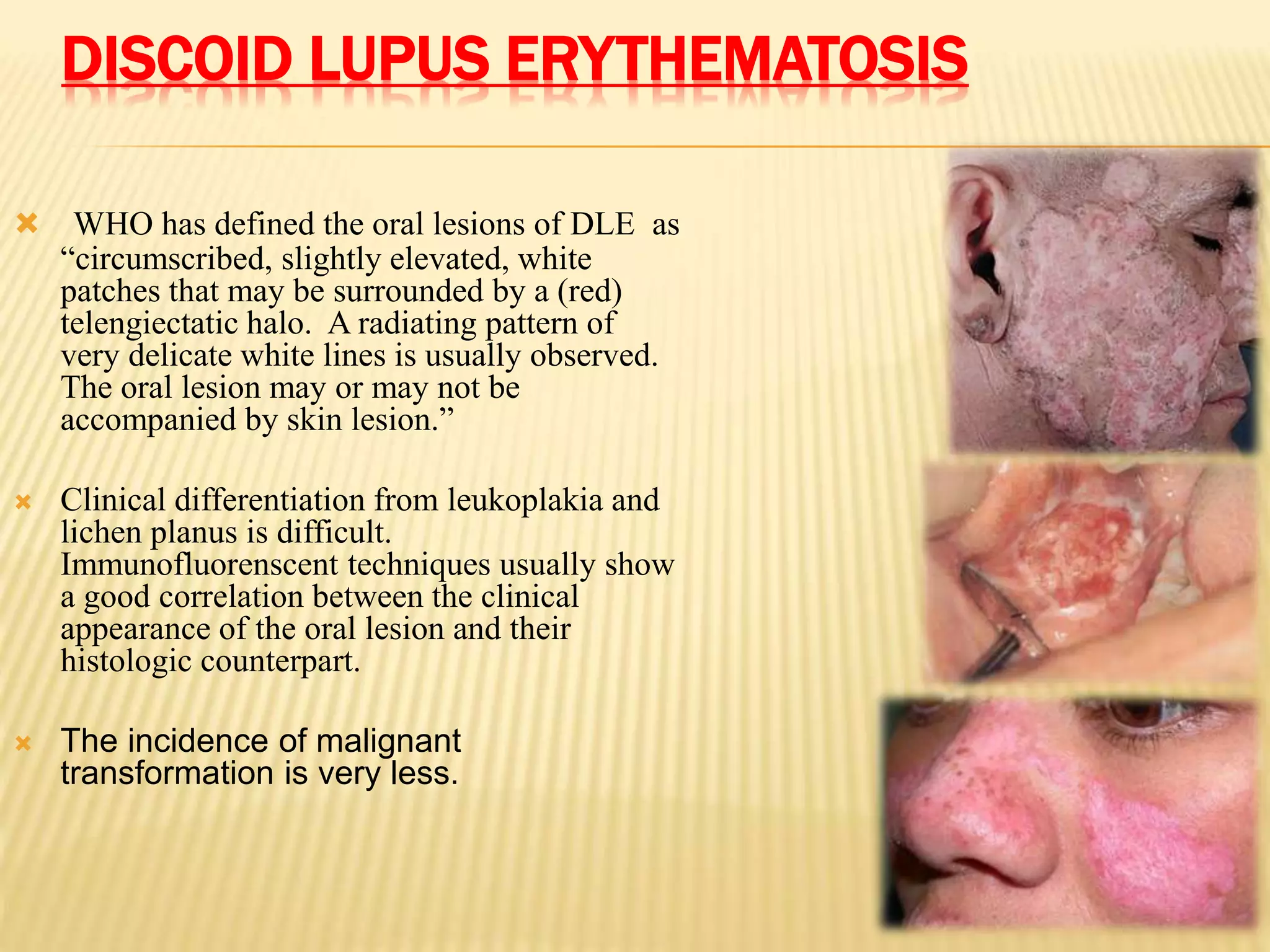 DISCOID LUPUS ERYTHEMATOSIS
 WHO has defined the oral lesions of DLE as
“circumscribed, slightly elevated, white
patches that may be surrounded by a (red)
telengiectatic halo. A radiating pattern of
very delicate white lines is usually observed.
The oral lesion may or may not be
accompanied by skin lesion.”
 Clinical differentiation from leukoplakia and
lichen planus is difficult.
Immunofluorenscent techniques usually show
a good correlation between the clinical
appearance of the oral lesion and their
histologic counterpart.
 The incidence of malignant
transformation is very less.
 
