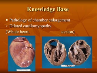 Knowledge Base  Pathology of chamber enlargement  Dilated cardiomyopathy  ( Whole heart ,    section )  