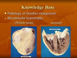 Knowledge Base  Pathology of chamber enlargement  Biventricular hypertrophy   ( Whole heart ,  section )  