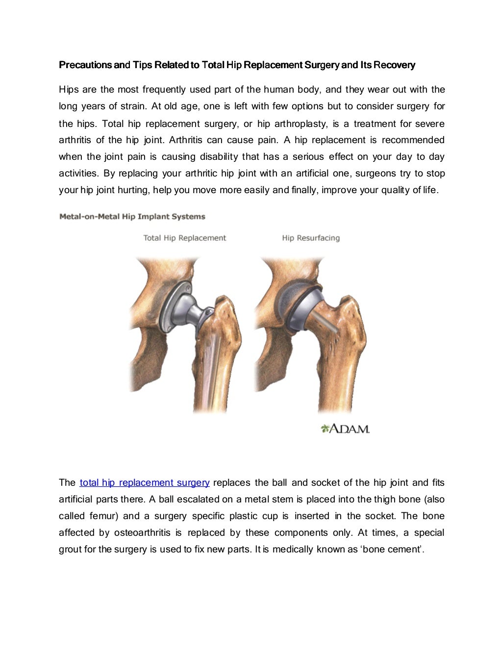 Precautions and tips related to total hip replacement surgery and its recovery