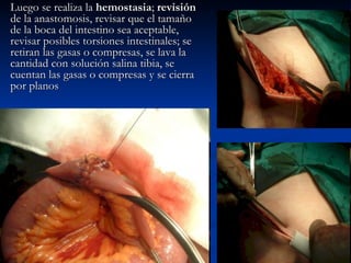 Luego se realiza la  hemostasia ;  revisión  de la anastomosis, revisar que el tamaño de la boca del intestino sea aceptable, revisar posibles torsiones intestinales; se retiran las gasas o compresas, se lava la cantidad con solución salina tibia, se cuentan las gasas o compresas y se cierra por planos 