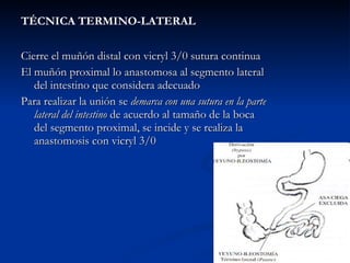 TÉCNICA TERMINO-LATERAL Cierre el muñón distal con vicryl 3/0 sutura continua El muñón proximal lo anastomosa al segmento lateral del intestino que considera adecuado Para realizar la unión se  demarca con una sutura en la parte lateral del intestino  de acuerdo al tamaño de la boca del segmento proximal, se incide y se realiza la anastomosis con vicryl 3/0 