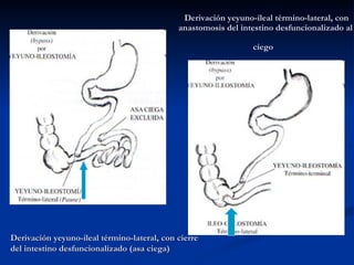 Derivación yeyuno-ileal término-lateral, con anastomosis del intestino desfuncionalizado al ciego   Derivación yeyuno-ileal término-lateral, con cierre del intestino desfuncionalizado (asa ciega) 