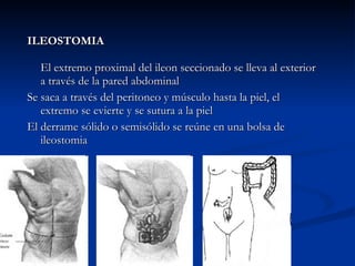 ILEOSTOMIA El extremo proximal del ileon seccionado se lleva al exterior a través de la pared abdominal Se saca a través del peritoneo y músculo hasta la piel, el extremo se evierte y se sutura a la piel El derrame sólido o semisólido se reúne en una bolsa de ileostomia 