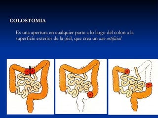 COLOSTOMIA Es una apertura en cualquier parte a lo largo del colon a la superficie exterior de la piel, que crea un  ano artificial 