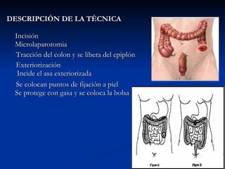 DESCRIPCIÓN DE LA TÉCNICA Incisión  Microlaparotomia Tracción del colon y se libera del epiplón Exteriorización  Incide el asa exteriorizada Se colocan puntos de fijación a piel  Se protege con gasa y se coloca la bolsa 