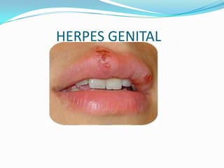 HERPES GENITAL