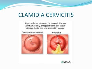 CLAMIDIA CERVICITIS