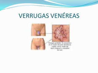 VERRUGAS VENÉREAS