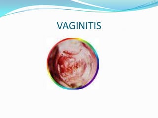 VAGINITIS
