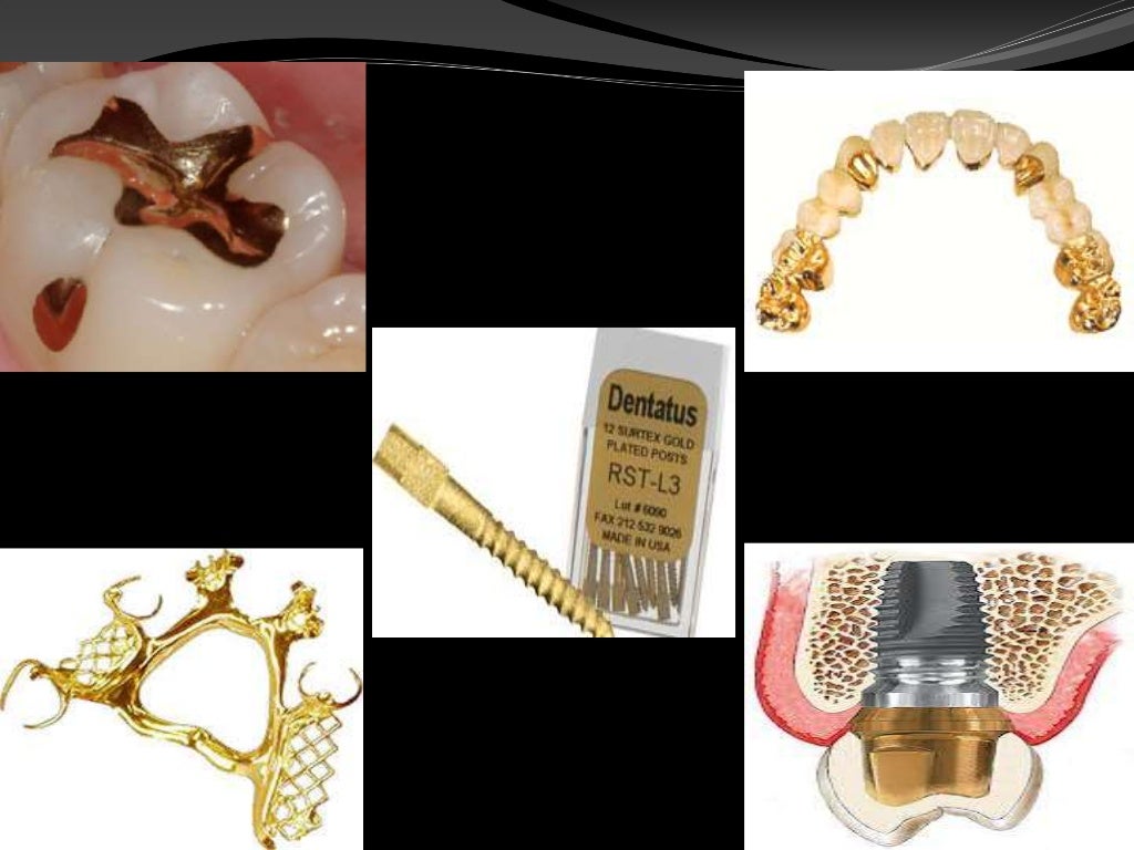 Precious metal alloys in dentistry