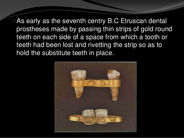 Gold Prongs Clipped To Eye Teeth