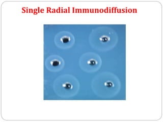 Single Radial Immunodiffusion
 