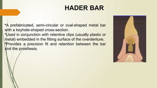PRECISION ATTACHMENTS and their significance in dentistry.pptx