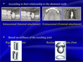 Rectangular Attachment Comprehensive Overview of Precision Attachments in Dentistry: Types ...