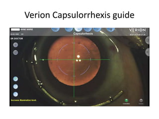 Verion Capsulorrhexis guide
 