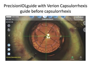 PrecisionIOLguide with Verion Capsulorrhexis
guide before capsulorrhexis
 