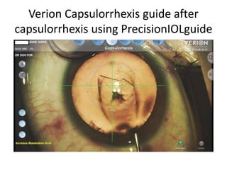 Verion Capsulorrhexis guide after
capsulorrhexis using PrecisionIOLguide
 