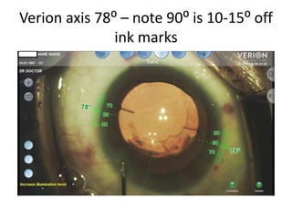 Verion axis 78⁰ – note 90⁰ is 10-15⁰ off
ink marks
 