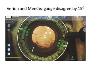 Verion and Mendez gauge disagree by 15⁰
 