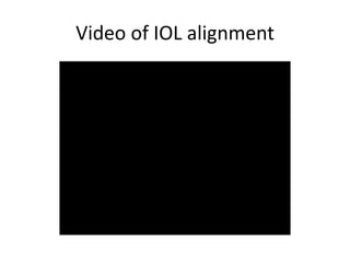 Video of IOL alignment
 