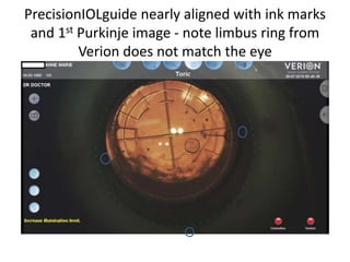 PrecisionIOLguide nearly aligned with ink marks
and 1st Purkinje image - note limbus ring from
Verion does not match the eye
 