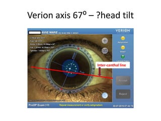 Verion axis 67⁰ – ?head tilt
Inter-canthal line
 