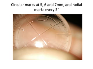 Circular marks at 5, 6 and 7mm, and radial
marks every 5°
 