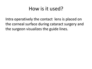 How is it used?
Intra operatively the contact lens is placed on
the corneal surface during cataract surgery and
the surgeon visualizes the guide lines.
 