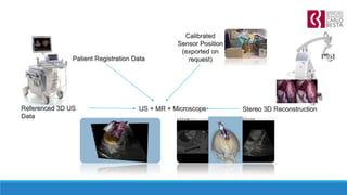Calibrated
Sensor Position
(exported on
request)
Stereo 3D Reconstruction
Patient Registration Data
Referenced 3D US
Data
US + MR + Microscope
 