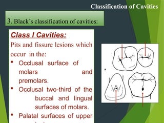 Comprehensive Guide to Cavity Classification and Nomenclature in ...