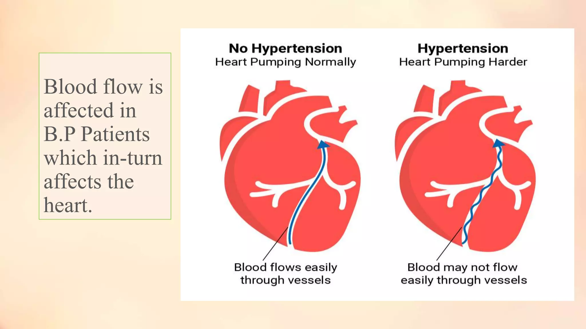 Blood flow is
affected in
B.P Patients
which in-turn
affects the
heart.
 