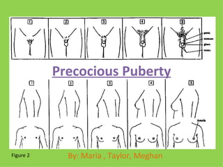 Precocious Puberty By: Maria , Taylor, Meghan Figure 2 