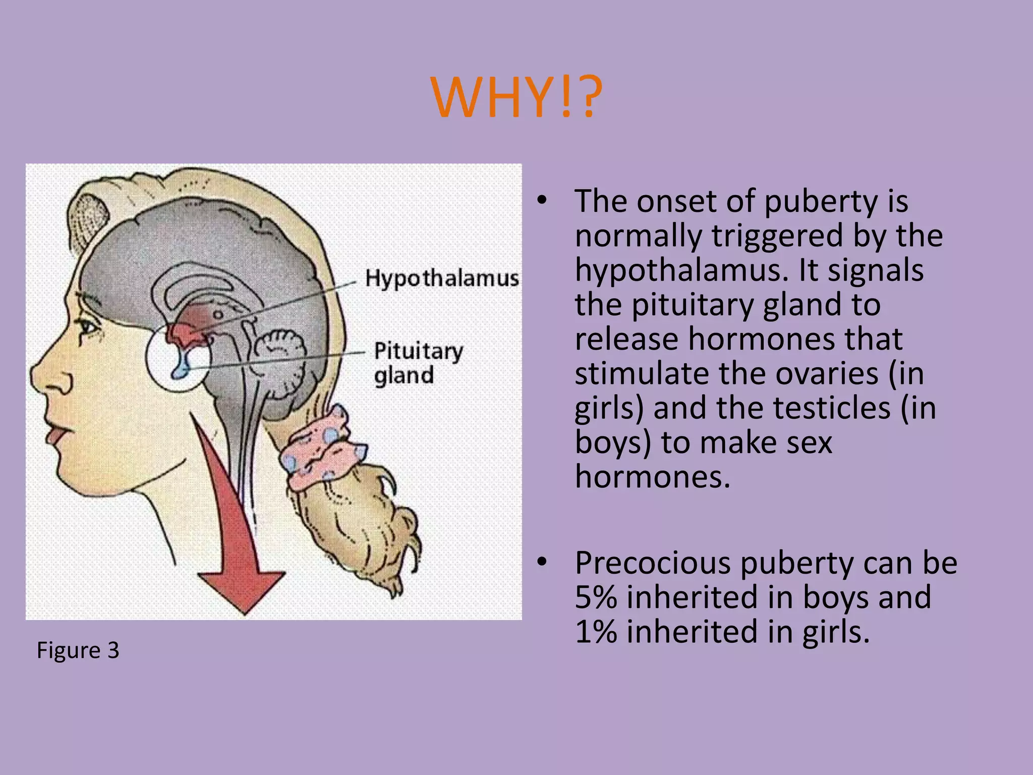 Precocious Puberty PPTX precocious-puberty-pptx