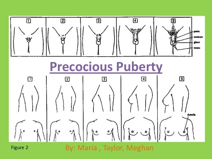 precocious puberty precocious puberty