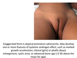 Exaggerated form is atypical premature adrenarche. May develop
one or more features of systemic androgen effect, such as marked
       growth acceleration, clitoral (girls) or phallic (boys)
enlargement, cystic acne, or advanced bone age (>2 SD above the
                         mean for age).
 
