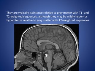 They are typically isointense relative to gray matter with T1- and
T2-weighted sequences, although they may be mildly hyper- or
hypointense relative to gray matter with T2-weighted sequences
 
