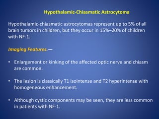 Hypothalamic-Chiasmatic Astrocytoma
Hypothalamic-chiasmatic astrocytomas represent up to 5% of all
brain tumors in children, but they occur in 15%–20% of children
with NF-1.
Imaging Features.—
• Enlargement or kinking of the affected optic nerve and chiasm
are common.
• The lesion is classically T1 isointense and T2 hyperintense with
homogeneous enhancement.
• Although cystic components may be seen, they are less common
in patients with NF-1.
 