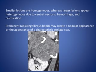 Smaller lesions are homogeneous, whereas larger lesions appear
heterogeneous due to central necrosis, hemorrhage, and
calcification.
Prominent radiating fibrous bands may create a nodular appearance
or the appearance of a characteristic stellate scar.
 
