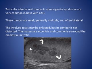 Testicular adrenal rest tumors in adrenogenital syndrome are
very common in boys with CAH.
These tumors are small, generally multiple, and often bilateral.
The involved testis may be enlarged, but its contour is not
distorted. The masses are eccentric and commonly surround the
mediastinum testis.
 