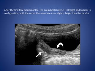 After the first few months of life, the prepubertal uterus is straight and tubular in
configuration, with the cervix the same size as or slightly larger than the fundus .
 