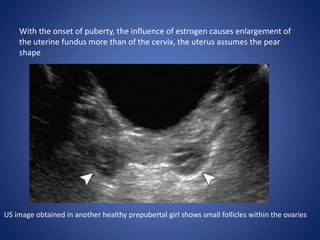 With the onset of puberty, the influence of estrogen causes enlargement of
the uterine fundus more than of the cervix, the uterus assumes the pear
shape
US image obtained in another healthy prepubertal girl shows small follicles within the ovaries
 