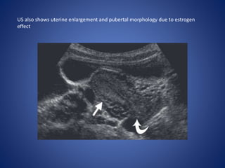 US also shows uterine enlargement and pubertal morphology due to estrogen
effect
 