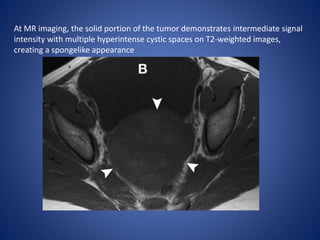 At MR imaging, the solid portion of the tumor demonstrates intermediate signal
intensity with multiple hyperintense cystic spaces on T2-weighted images,
creating a spongelike appearance
 
