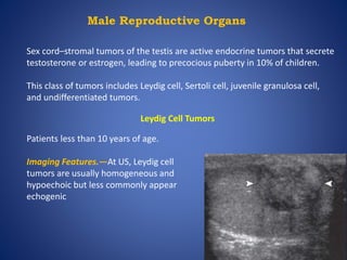 Male Reproductive Organs
Sex cord–stromal tumors of the testis are active endocrine tumors that secrete
testosterone or estrogen, leading to precocious puberty in 10% of children.
This class of tumors includes Leydig cell, Sertoli cell, juvenile granulosa cell,
and undifferentiated tumors.
Leydig Cell Tumors
Patients less than 10 years of age.
Imaging Features.—At US, Leydig cell
tumors are usually homogeneous and
hypoechoic but less commonly appear
echogenic
 