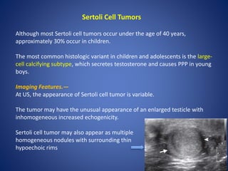 Sertoli Cell Tumors
Although most Sertoli cell tumors occur under the age of 40 years,
approximately 30% occur in children.
The most common histologic variant in children and adolescents is the large-
cell calcifying subtype, which secretes testosterone and causes PPP in young
boys.
Imaging Features.—
At US, the appearance of Sertoli cell tumor is variable.
The tumor may have the unusual appearance of an enlarged testicle with
inhomogeneous increased echogenicity.
Sertoli cell tumor may also appear as multiple
homogeneous nodules with surrounding thin
hypoechoic rims
 
