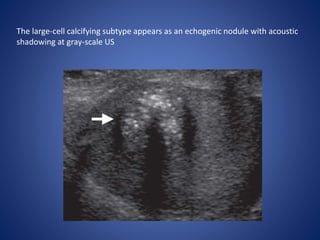 The large-cell calcifying subtype appears as an echogenic nodule with acoustic
shadowing at gray-scale US
 