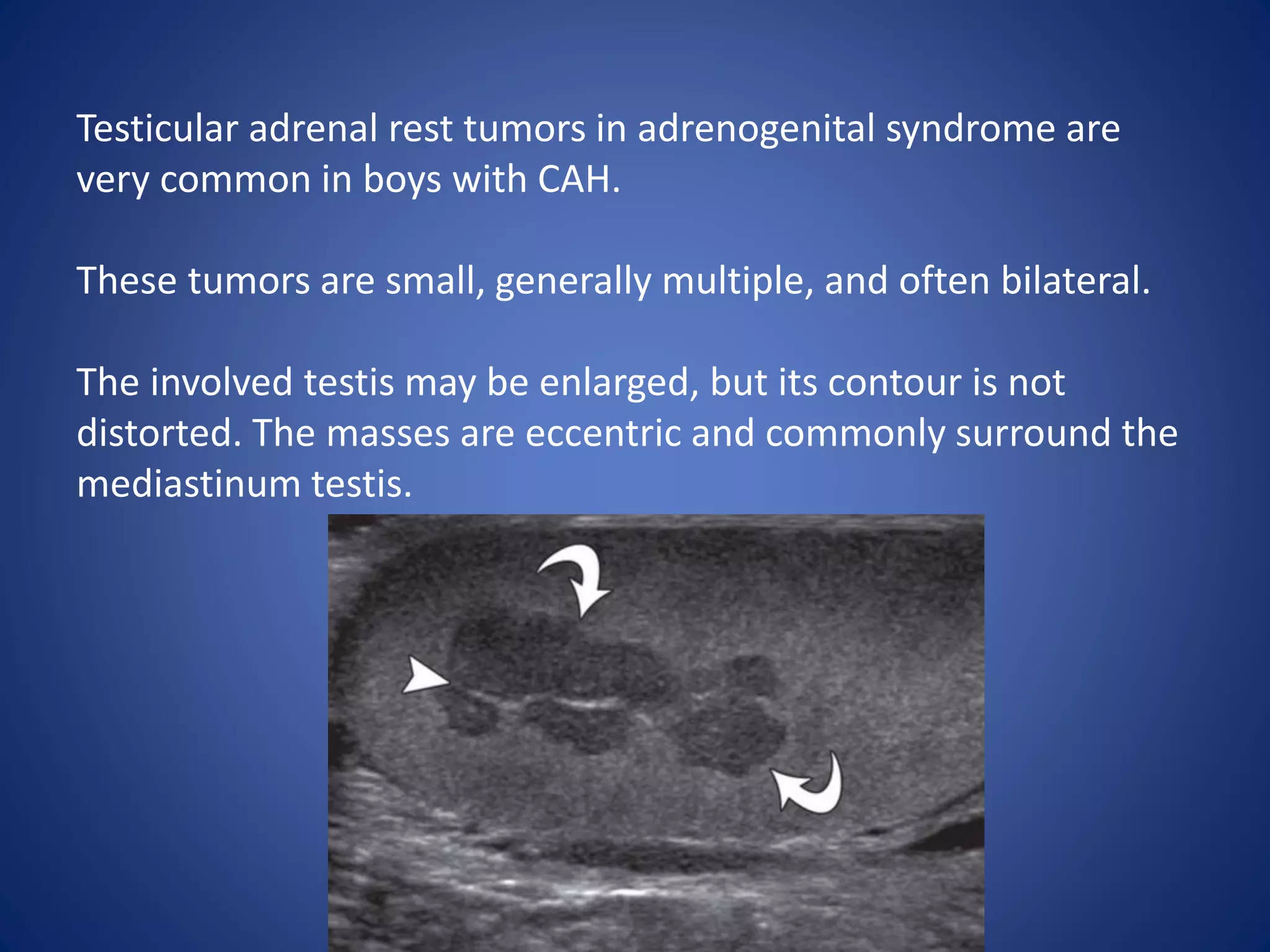 Testicular adrenal rest tumors in adrenogenital syndrome are
very common in boys with CAH.
These tumors are small, generally multiple, and often bilateral.
The involved testis may be enlarged, but its contour is not
distorted. The masses are eccentric and commonly surround the
mediastinum testis.
 